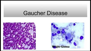 Gaucher Disease [upl. by Weight]