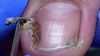 Wow Broken toenail with clotted blood hidden underneath【Doctor Liu Pedicure】 [upl. by Cybill43]