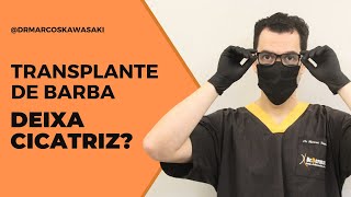 Transplante de barba deixa cicatriz [upl. by Nalyd507]