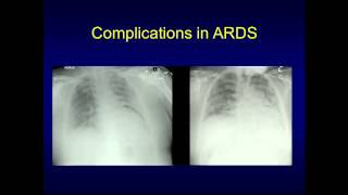 ARDS The Value of Pictures by Dr Rebecca Preston [upl. by Olin]