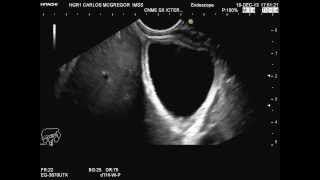 Pólipo de vesícula biliar diagnosticado por medio de Ultrasonido Endoscópico [upl. by Neils188]