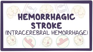 Hemorrhagic stroke intracerebral hemorrhage  causes symptoms diagnosis treatment pathology [upl. by Eisen]