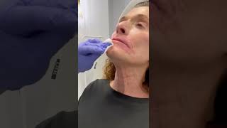 Botox for platysmal bands in the neck [upl. by Heringer]