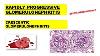 RPGN  Rapidly Progressive Glomerulonephritis  Poor Prognosis  Made Easy [upl. by Petie]