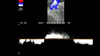 Doppler Venous reflux saphenofemoral junction reflux [upl. by Tiertza38]