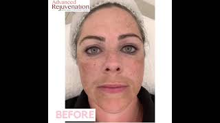 Cosmelan Treatment Results  Skin DePigmentation and Anti Ageing  By Advanced Rejuvenation [upl. by Sulienroc]