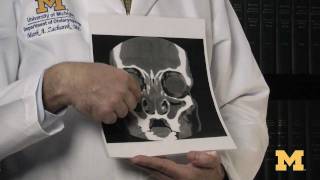 How do I know if I need sinus surgery [upl. by Busey]