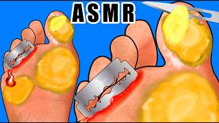 ASMR Foot Treatment  Removing Thick Dead Skin Calluses and Plantar Warts Animation  Tingle Sound [upl. by Caritta]