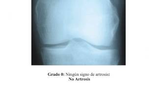 Artrosis de rodilla graduación radiologica Dr Carlos fernández López CHUAC A Coruña Spain [upl. by Mikkel]