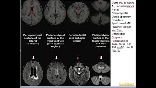 40 Neuromyelitis optica NMO demyelination aquaporine 4 antibodies circumventricular organs [upl. by Belen213]