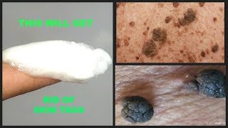 HOW TO GET RID OF SKIN TAGS AT HOME USING 2 INGREDIENTS  BAKING SODA  CASTOR OIL  Khichi Beauty [upl. by Feinberg]