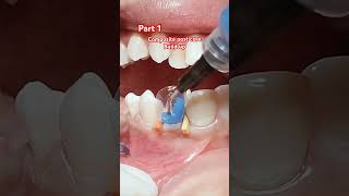 COMPOSITE POST ampCORE Part 1 [upl. by Connelley]