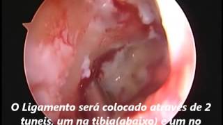 Cirurgia de Ligamento cruzado Anterior no Joelho [upl. by Tade351]