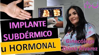 IMPLANTE SUBDERMICO U HORMONAL POR GINECOLOGA DIANA ALVAREZ [upl. by Eikcor]