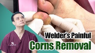 Welder’s Painful Corns amp Calluses Removal [upl. by Nancey]