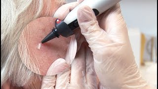 What Are Actinic Keratosis And Benign Lentigines [upl. by Assina]