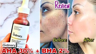 The Ordinary AHA BHA Peeling Solution Review  MAGIC in a Bottle🤔 [upl. by Tull]