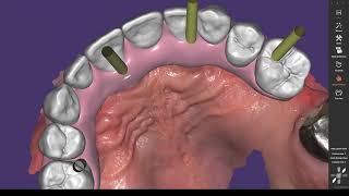 How to fix screw channel failure on Exocad for smooth import in to Blenderfordental [upl. by Haropizt]