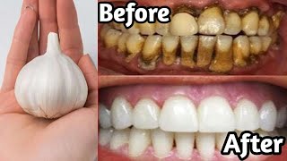 सिर्फ 2 मिनट में दांतों को मोती जैसे चमकदार बनाने के घरेलू उपाय  Teeth Cleaning  Kitchen Tips [upl. by Stoneham448]