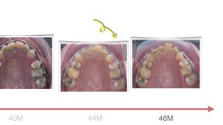 Class II Treatment with U1 Ankylosis｜【Chris Chang Ortho】CC755 [upl. by Birecree]