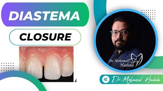 Diastema Closure  Dr Mohamed Hadida [upl. by Eugatnom80]