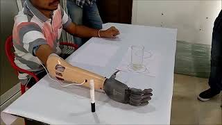 Myoelectric prosthetic hand fitment trial [upl. by Ikciv253]