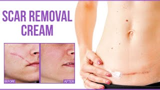 5 Best Scar Removal Cream  Skin Scar Treatment That Actually Works [upl. by Elfrida]