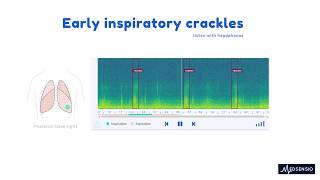 Lung sounds  Early inspiratory crackles [upl. by Nylloh]