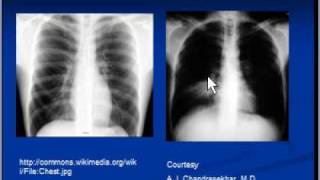 Chest xray interpretation  Lung consolidation and main causes [upl. by Berriman]