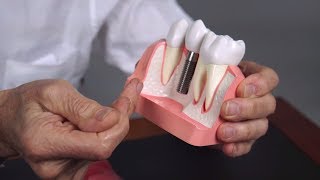 LAPIP Treating Dental Implant Problems and PeriImplantitis [upl. by Dnalrah]