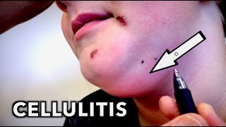 RARE CELLULITIS amp Impetigo Ultra Funny Kid  Dr Paul [upl. by Goraud]