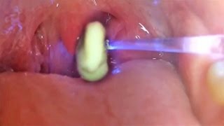 Worlds Greatest Tonsil Stone Removals 2 [upl. by Halyk368]