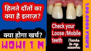 दांत हिलते हों तो क्या करें MOBILE TEETH its solutionsजाने क्या होगा खर्च  DrPraveen Bhatia [upl. by Rozella]