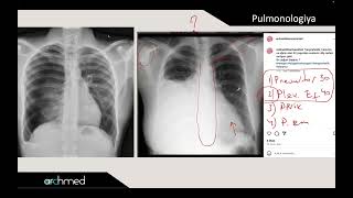 Pneumothorax vs Pleural effusion [upl. by Bushweller]