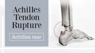 Achilles tendon rupture [upl. by Ainegue598]