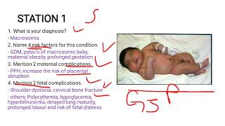 Macrosomia Case Study [upl. by Sadella]