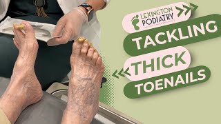 Tackling Thick Toenails [upl. by Boj400]