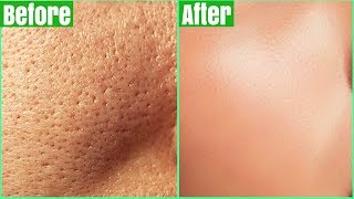 How To Get Rid Of LARGE PORES PERMANENTLY 100 Works Shrink amp Get Clear Glass Skin Naturally [upl. by Mcilroy]