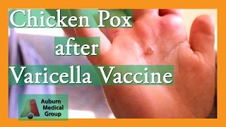 Chicken Pox after Varicella Vaccine  Auburn Medical Group [upl. by Nilrem]