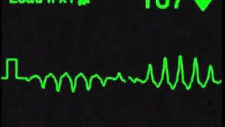 Torsades de Pointes  ECG Simulator  Arrhythmia Simulator [upl. by Gaiser512]