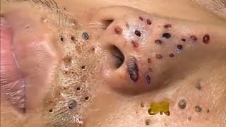 Blackhead Removal With Sac Dep Spa 1000334 [upl. by Anirtruc]