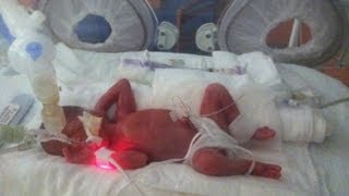 Born at 25 Weeks MicroPreemie Documentary [upl. by Alber]