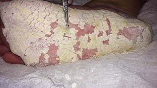 Extreme dry cracked feet skin removal after treatment [upl. by Kcirrek]