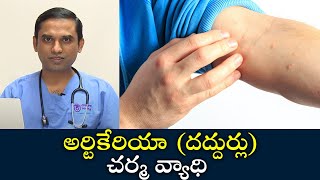 Urticaria skin disease  Samayam Telugu [upl. by Etnovaj]