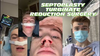 Septoplasty Turbinate Reduction Surgery Recovery vlog  tips ￼ [upl. by Aleahpar151]