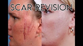 Scar Revision [upl. by Kendre]