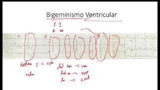 Bigeminismo y Trigeminismo  Extrasistole Auricular y Ventricular EKG [upl. by Anirdna]