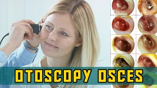 OTOSCOPY OSCEs  PLAB Image Reference [upl. by Martelle]