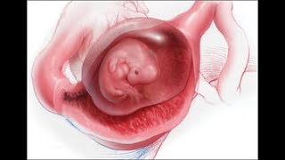 ECTOPIC PREGNANCY [upl. by Effy]