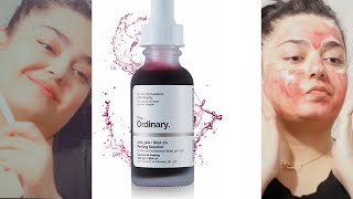 THE ORDINARY AHA BHA PEELING SOLUTION [upl. by Rhynd119]